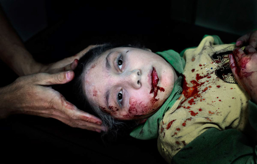 Aleppo, 2012. Dania Kilsi, 11, behandlas för splitterskador. Hon och hennes yngre syskon, Zaid och Fatima, lekte utanför hemmet när en granat slog ner. Foto: NICLAS HAMMARSTRÖM (oktober 2012)